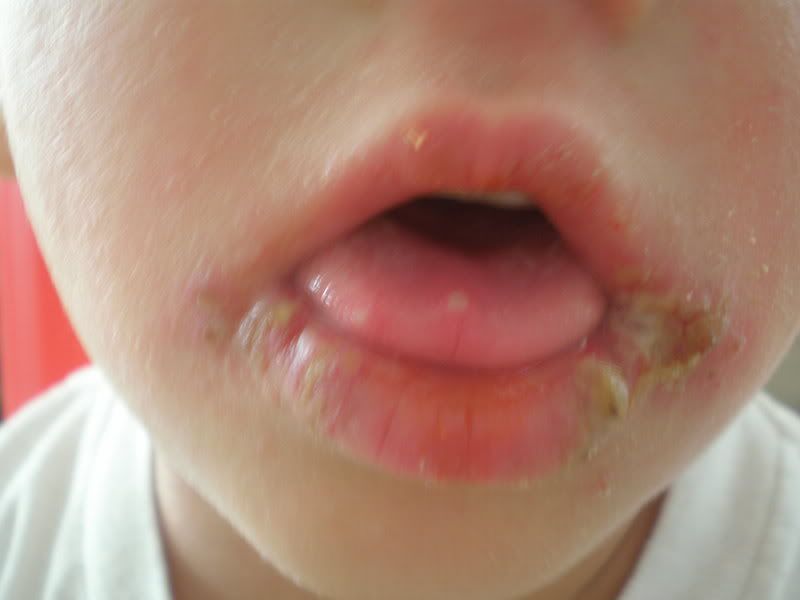 Staph Infection any experience? WAHM Forums