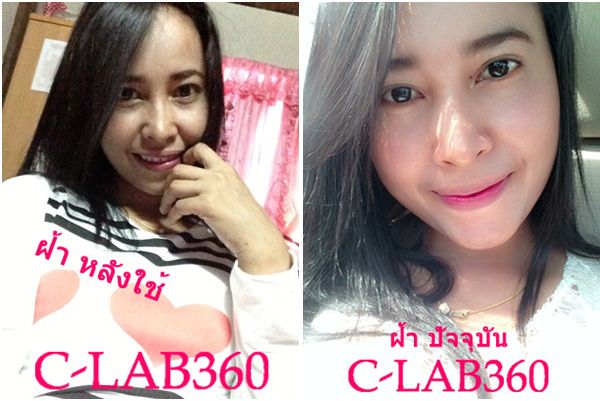 ฝ้า กระ จุดด่างดำ ฝ้า กระ จุดด่างดำ