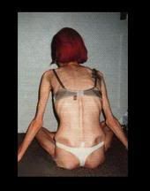 Anorexia Pictures, Images and Photos